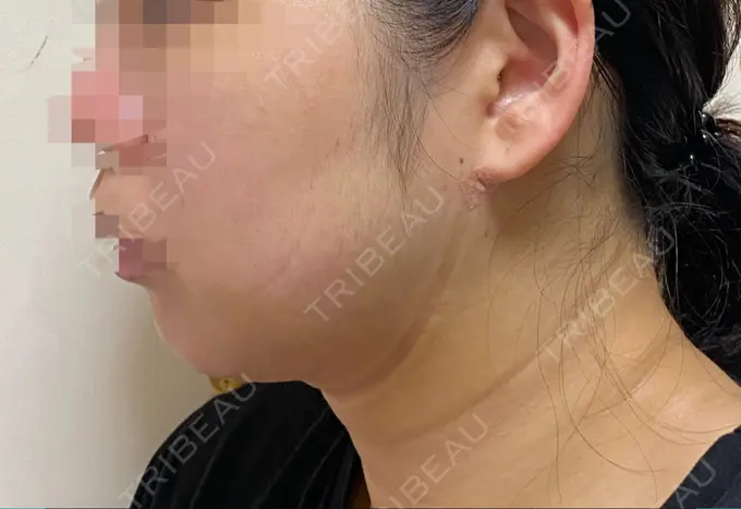 脂肪吸引（顔） THE CLINIC（ザ・クリニック） 福岡院 DAY 10 メイン用