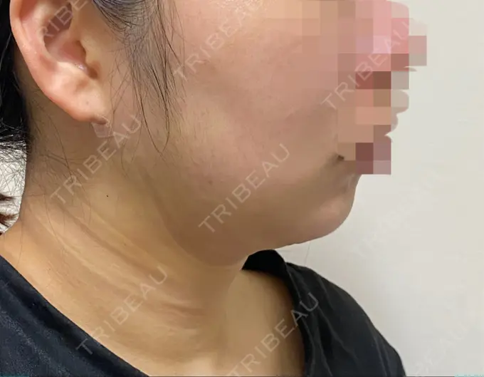 脂肪吸引（顔） THE CLINIC（ザ・クリニック） 福岡院 DAY 10 メイン用