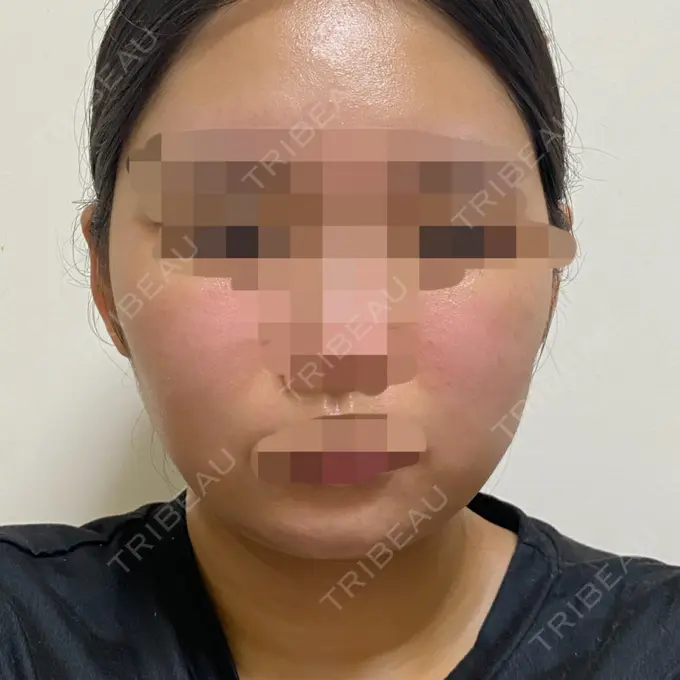 脂肪吸引（顔） THE CLINIC（ザ・クリニック） 福岡院 AFTER メイン用