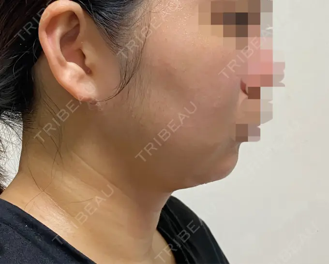 脂肪吸引（顔） THE CLINIC（ザ・クリニック） 福岡院 DAY 11 メイン用