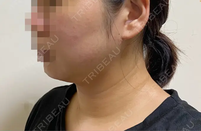 脂肪吸引（顔） THE CLINIC（ザ・クリニック） 福岡院 DAY 11 メイン用