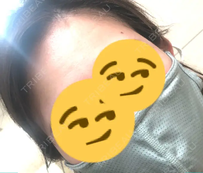 ヒアルロン酸注入（こめかみ） ルラ美容クリニック 渋谷本院 DAY 128 メイン用