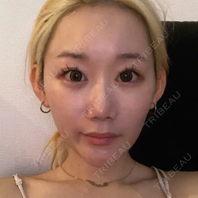 目頭切開 / 目尻切開 くさのたろうクリニック AFTER メイン用