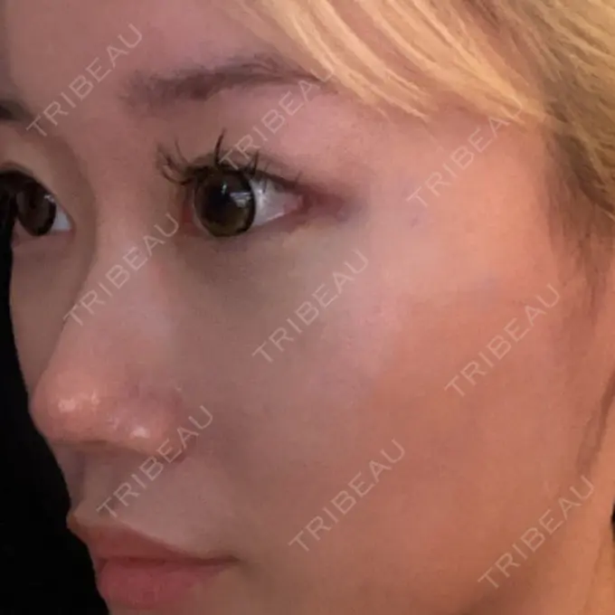 目頭切開 / 目尻切開 くさのたろうクリニック DAY 24 メイン用