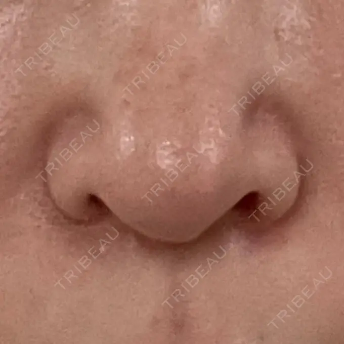 鼻中隔延長（切開） / 小鼻縮小（切開） / 軟骨移植 牧野美容クリニック AFTER メイン用