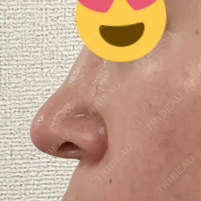 鼻中隔延長（切開） / 小鼻縮小（切開） / 軟骨移植 牧野美容クリニック DAY 44 メイン用