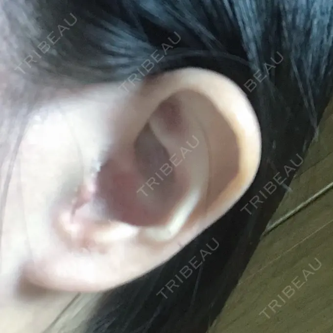 鼻尖形成（切開） / 軟骨移植 / 鼻尖縮小 / その他（鼻） みずほクリニック DAY 11 メイン用