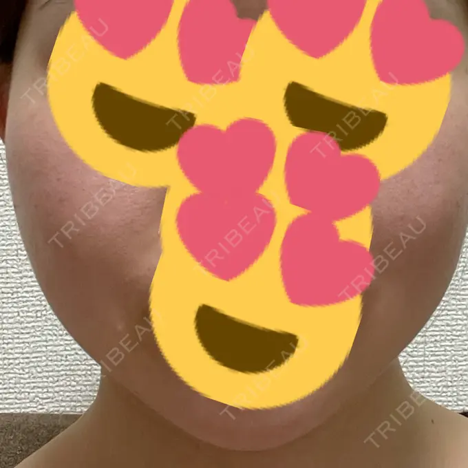 ボトックス（エラ・小顔） TCB東京中央美容外科 福岡天神院 DAY 5 メイン用