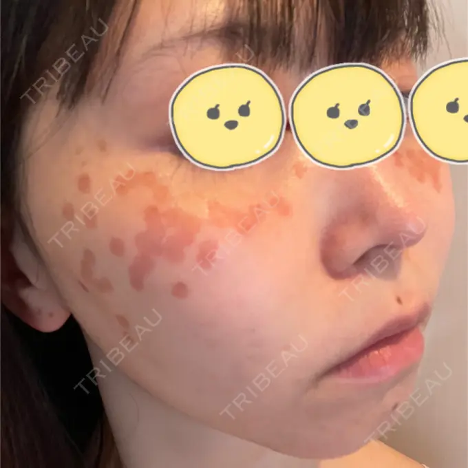 ルビーレーザー みずほクリニック DAY 4 メイン用