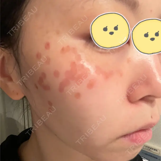 ルビーレーザー みずほクリニック DAY 5 メイン用