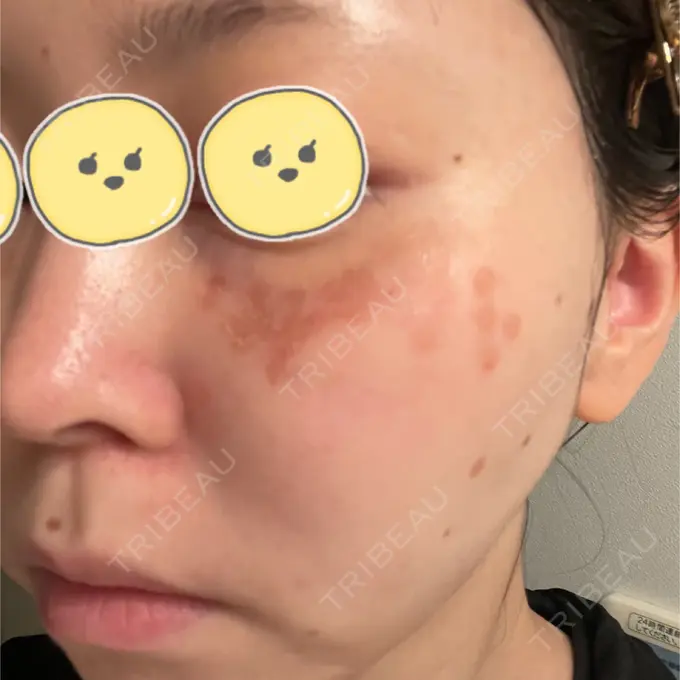 ルビーレーザー みずほクリニック DAY 5 メイン用