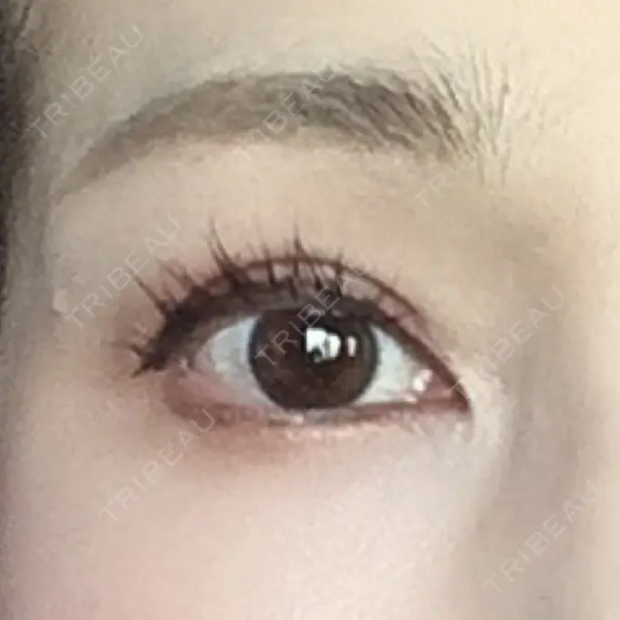 眉下切開 湘南美容クリニック 秋葉原院 DAY 561 メイン用