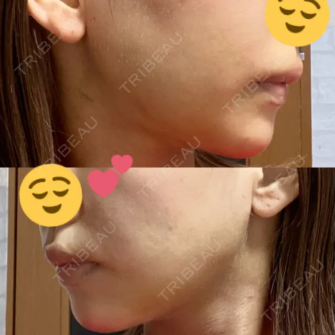 糸リフト / 脂肪吸引（顔） / メーラーファット除去 / 脂肪注入（輪郭） 湘南美容クリニック 秋葉原院 DAY 15 メイン用