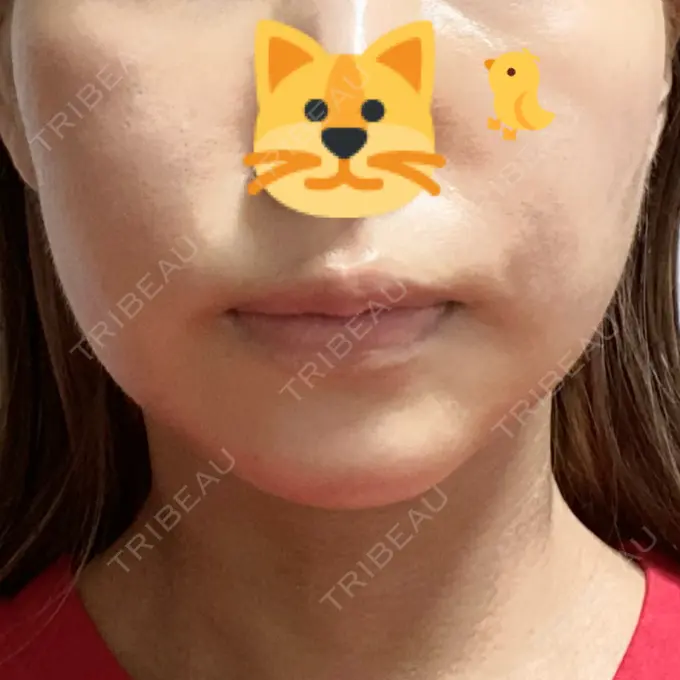 糸リフト / 脂肪吸引（顔） / メーラーファット除去 / 脂肪注入（輪郭） 湘南美容クリニック 秋葉原院 DAY 15 メイン用