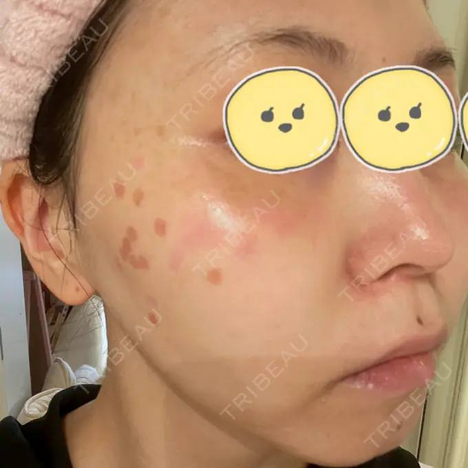 ルビーレーザー みずほクリニック DAY 6 メイン用