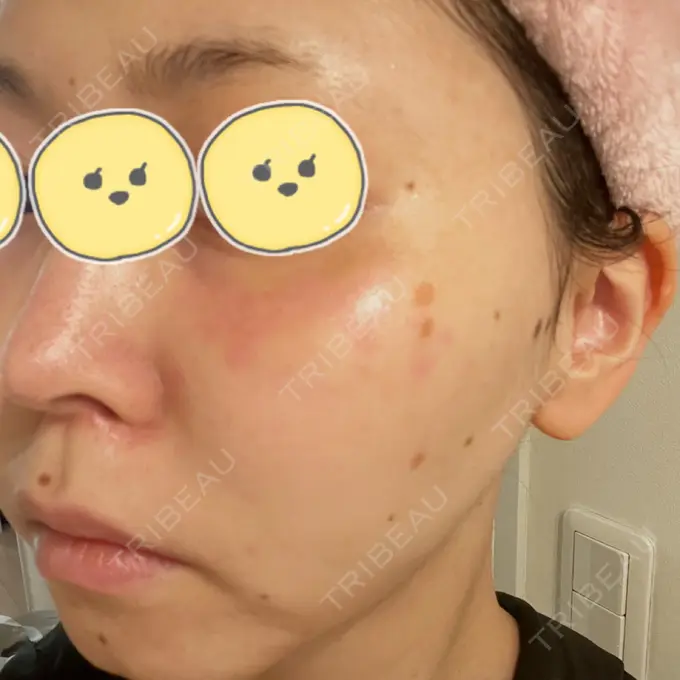 ルビーレーザー みずほクリニック DAY 6 メイン用