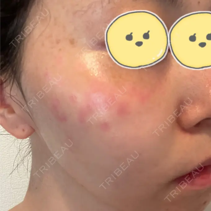 ルビーレーザー みずほクリニック DAY 7 メイン用