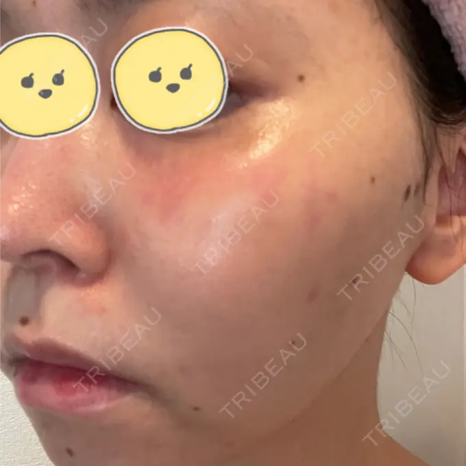 ルビーレーザー みずほクリニック DAY 7 メイン用