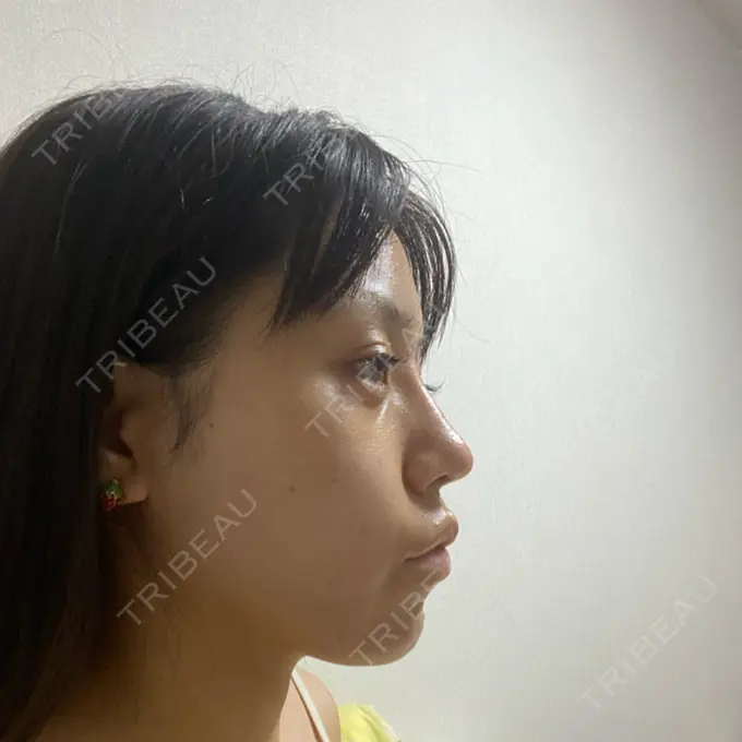 隆鼻術 / 鼻中隔延長（切開） みずほクリニック DAY 24 メイン用