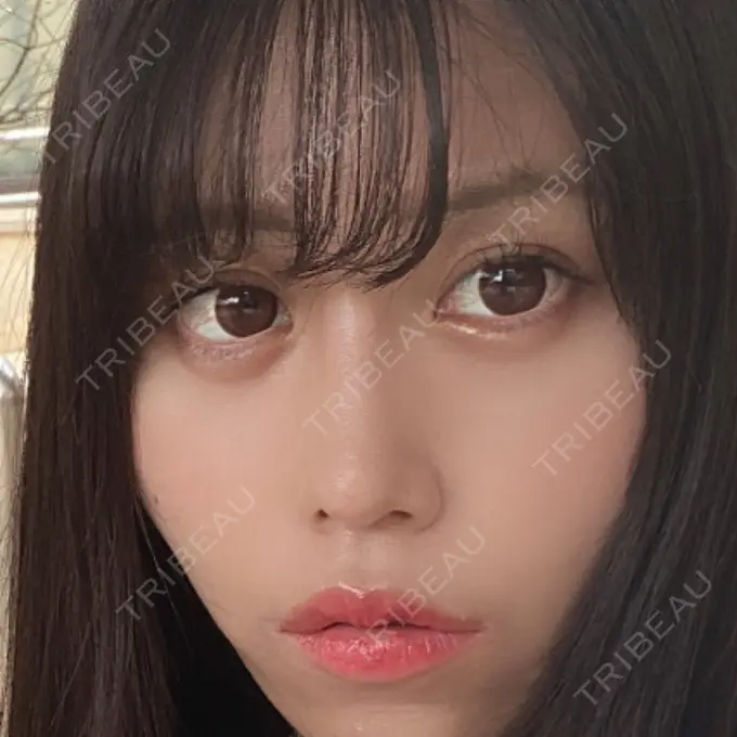 隆鼻術 / 鼻中隔延長（切開） みずほクリニック DAY 24 メイン用