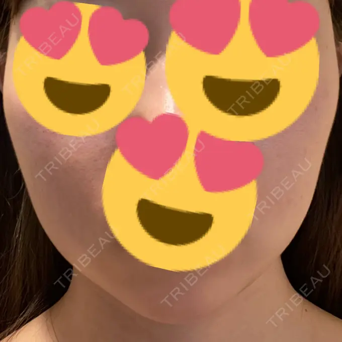 ボトックス（エラ・小顔） TCB東京中央美容外科 福岡天神院 DAY 1 メイン用