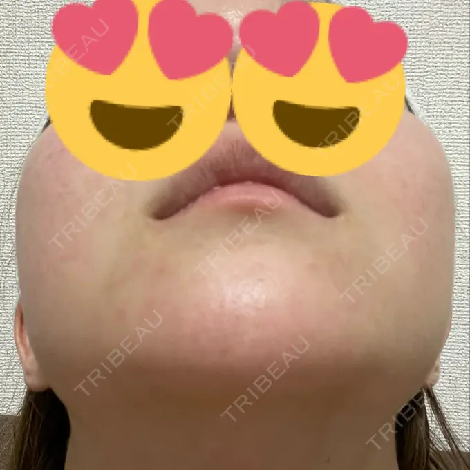 ボトックス（エラ・小顔） TCB東京中央美容外科 福岡天神院 DAY 18 メイン用