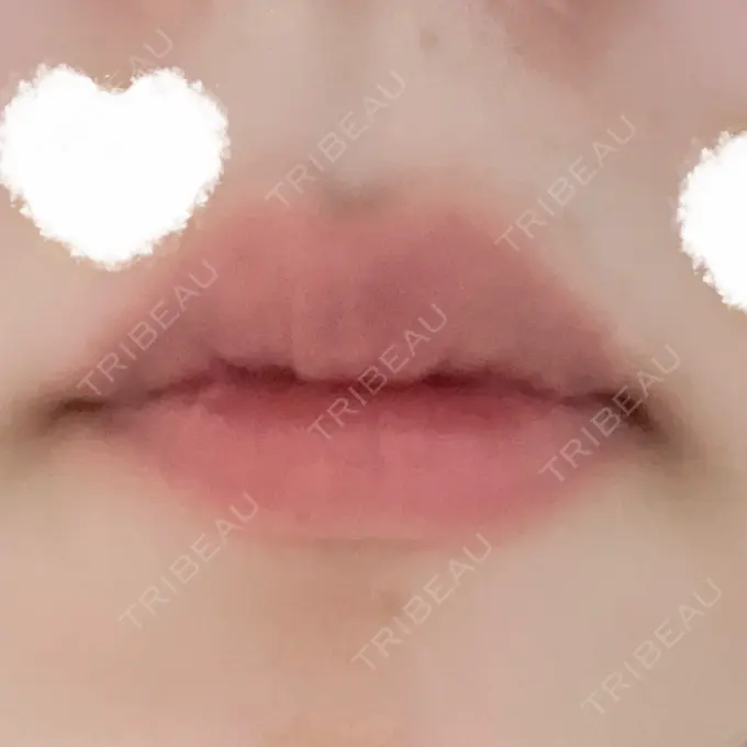 口角挙上 宇都宮竹内クリニック DAY 34 メイン用