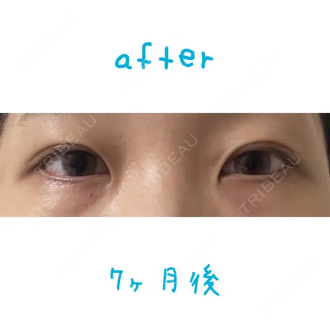 二重埋没 湘南美容クリニック 大阪あべの院 AFTER メイン用