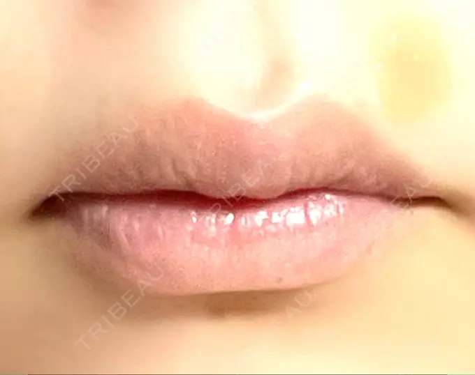 口角挙上 宇都宮竹内クリニック DAY 36 メイン用