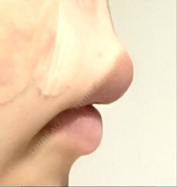 口角挙上 宇都宮竹内クリニック DAY 36 メイン用