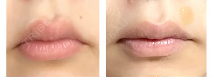 口角挙上 宇都宮竹内クリニック DAY 36 メイン用