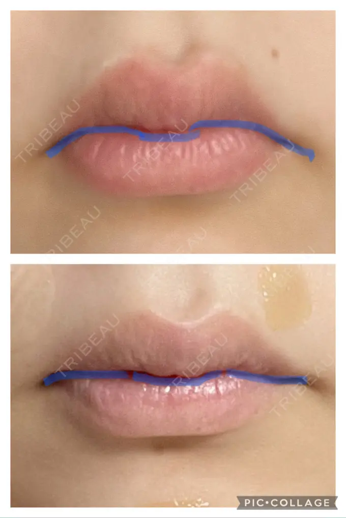 口角挙上 宇都宮竹内クリニック DAY 36 メイン用