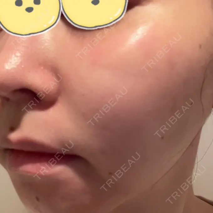 ルビーレーザー みずほクリニック DAY 10 メイン用