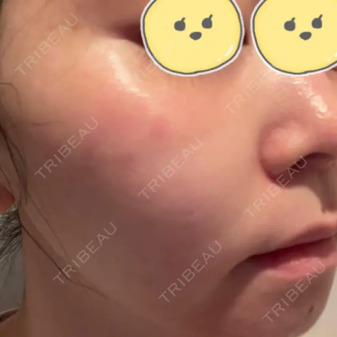 ルビーレーザー みずほクリニック AFTER メイン用