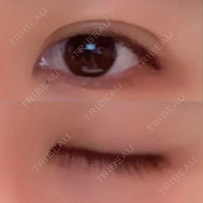 二重埋没 ハナビューティークリニック DAY 60 メイン用