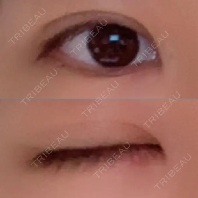 二重埋没 ハナビューティークリニック DAY 60 メイン用