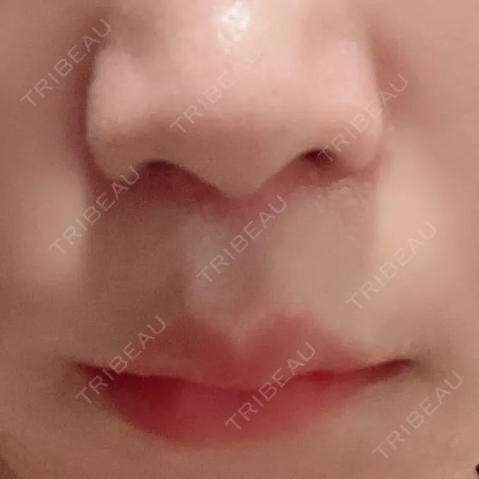 人中短縮 新宿ラクル美容外科クリニック 新宿院 AFTER メイン用