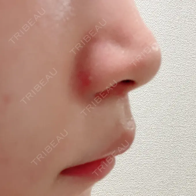 人中短縮 新宿ラクル美容外科クリニック 新宿院 DAY 122 メイン用