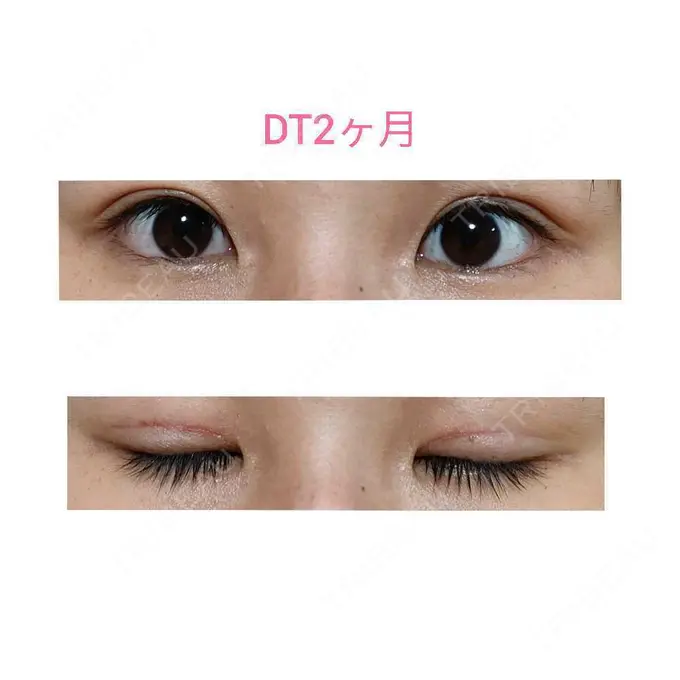 二重切開 / 眼瞼下垂（切開） 城本クリニック 福岡院 DAY 60 メイン用
