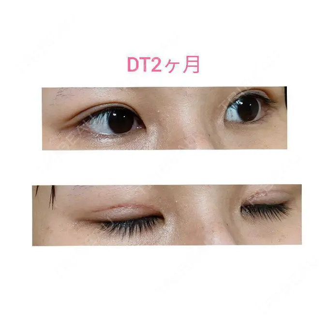 二重切開 / 眼瞼下垂（切開） 城本クリニック 福岡院 DAY 60 メイン用