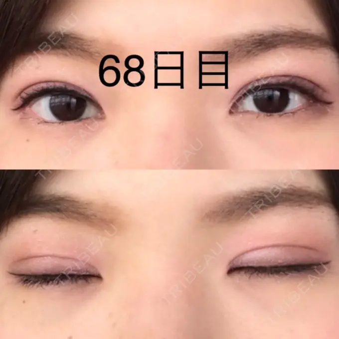 二重切開 / 上まぶたたるみ取り / 上まぶたの脂肪取り 城本クリニック 豊橋院 DAY 68 メイン用