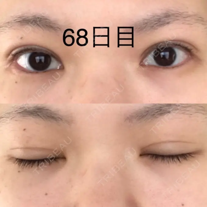 二重切開 / 上まぶたたるみ取り / 上まぶたの脂肪取り 城本クリニック 豊橋院 DAY 68 メイン用