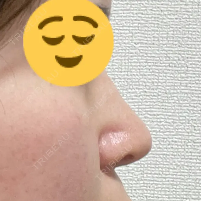 鼻修正 / 鼻孔縁下降 牧野美容クリニック DAY 14 メイン用