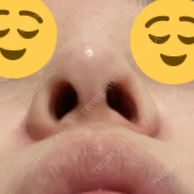 鼻修正 / 鼻孔縁下降 牧野美容クリニック DAY 14 メイン用