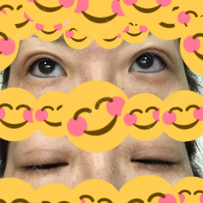 二重埋没 神戸元町ビューティークリニック DAY 130 メイン用