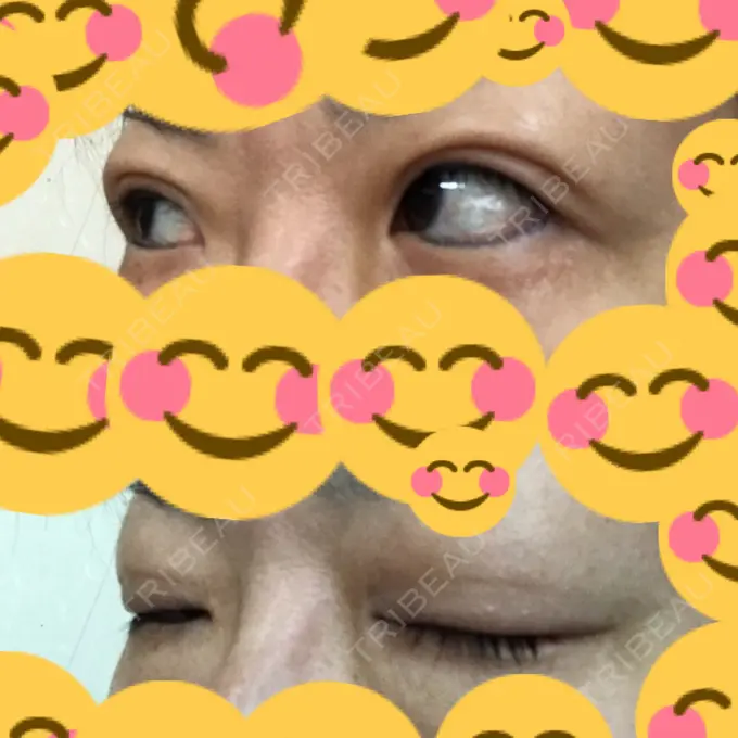 二重埋没 神戸元町ビューティークリニック DAY 130 メイン用