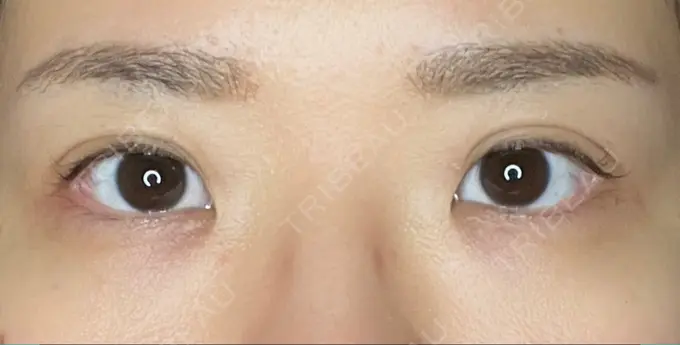 二重埋没 東京BELLEZZAクリニック DAY 143 メイン用