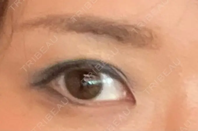 二重埋没 東京BELLEZZAクリニック DAY 143 メイン用