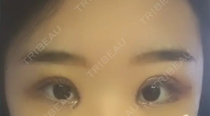 二重切開 / 目頭切開 / 眼瞼下垂（切開） / その他（目元） ブリスクリニック形成外科・美容外科・美容皮膚科 福岡 DAY 5 メイン用