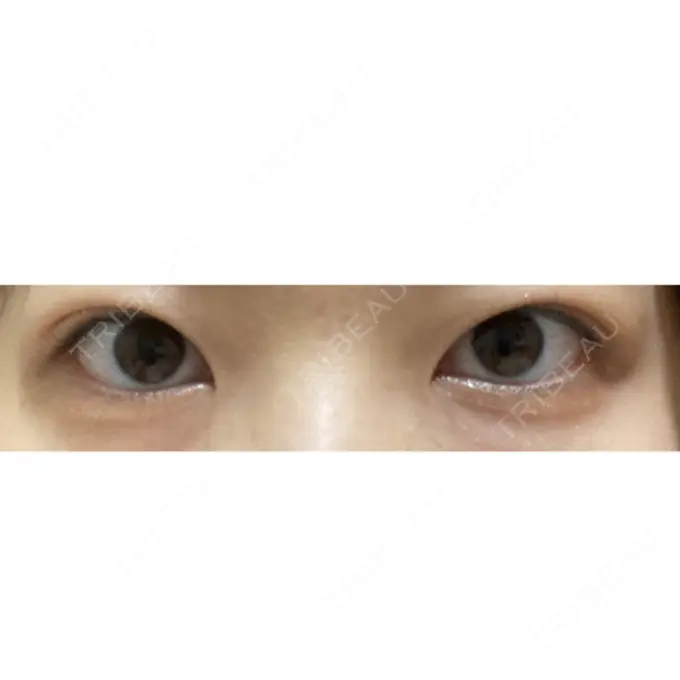 二重埋没 共立美容外科 大宮院 AFTER メイン用